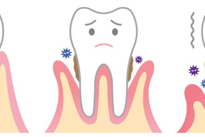 Enfermedad periodontal