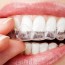 Fase de retención tras tratamiento de ortodoncia