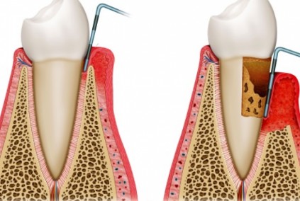 Avance de la enfermedad periodontal 